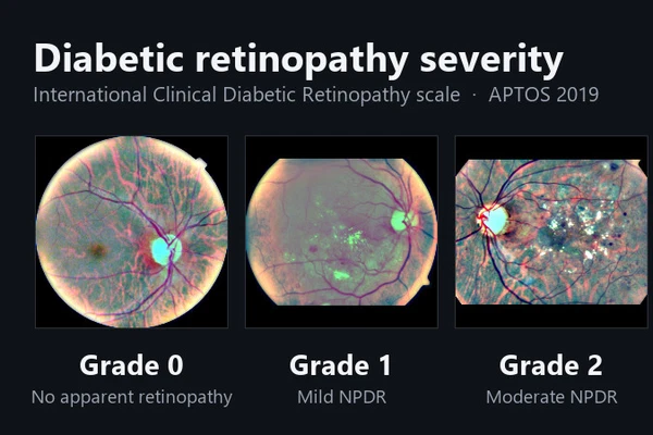 APTOS 2019 Blindness Detection